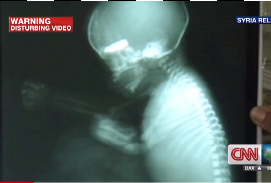 Röntgenbild på en ung flicka som skjutits till döds i mamman mage. Mamman överlevde.